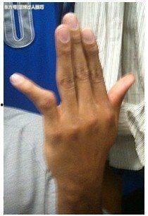手指脱臼图片,了解手指脱臼的成因与应对措施